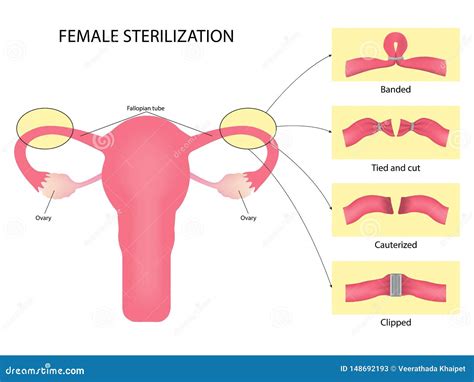 A Life-Changing Decision: Exploring the Benefits and Risks of Female Sterilization Tubal Ligation